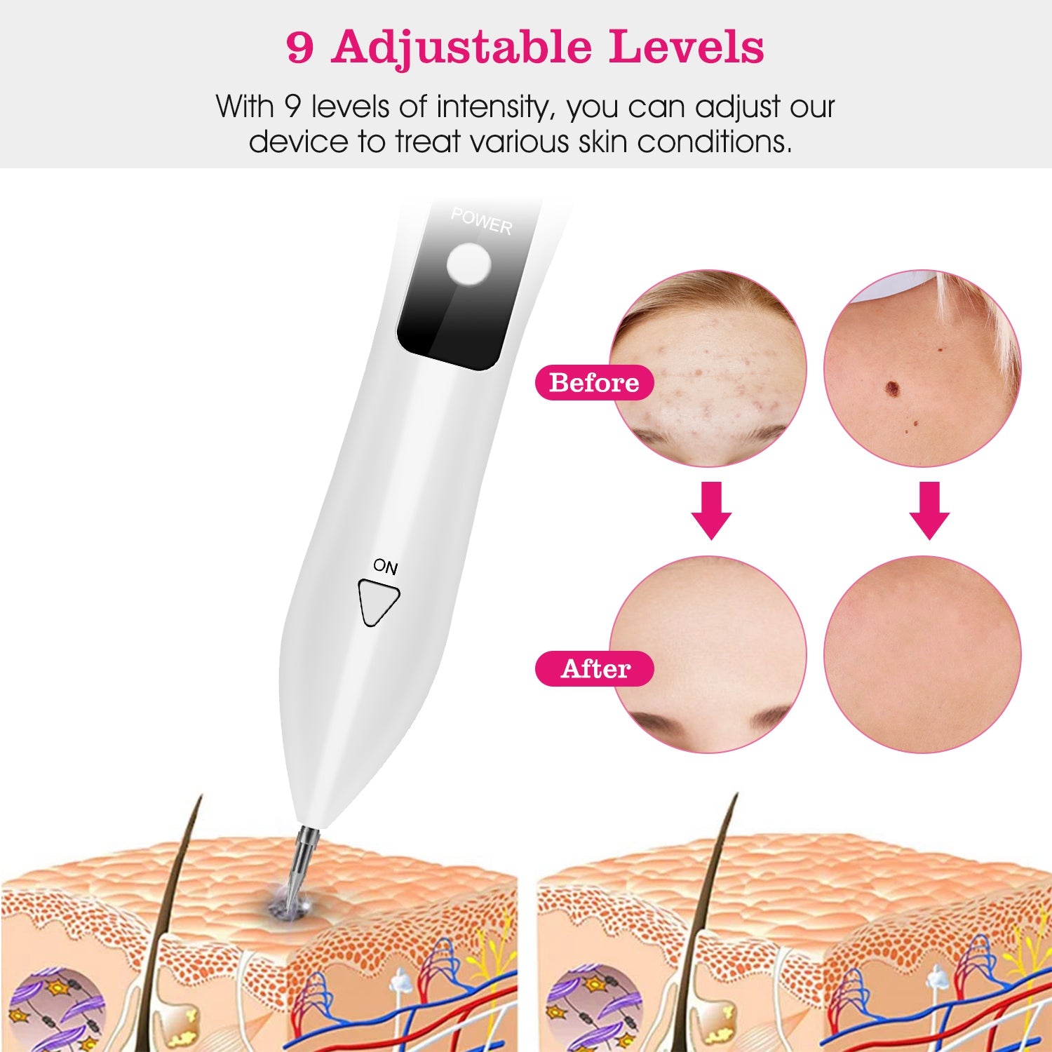 Advanced Skin Tag Remover Kit 9 Level Precision Spot Treatment